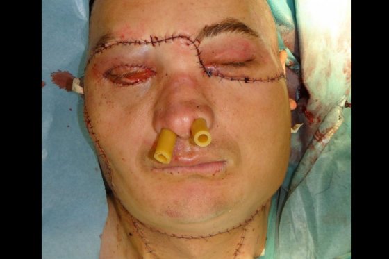 Imagen facilitada por el centro oncológico de Gliewice en la que se observa al paciente al que se le ha realizado el primer transplante total de cara en Polonia.