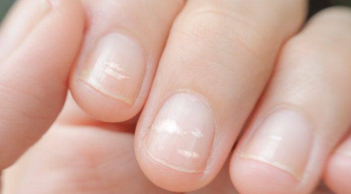 ¿Es verdad que las manchitas blancas de las uñas son por falta de calcio?