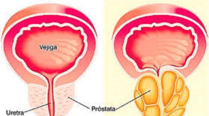 Revelan en RD mueren cuatro hombres diarios por cáncer de próstata