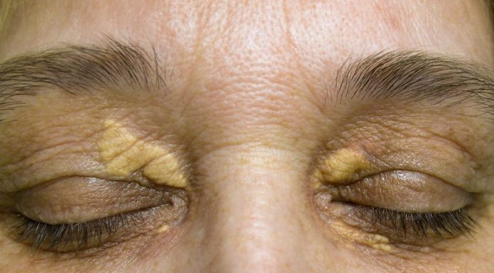 ¿Qué es el xantelasma y cómo se puede tratar?