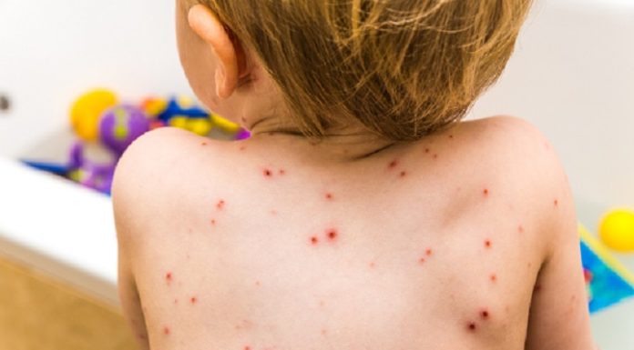 EVALUENLO..!! Ven menores 8 años deberían ser vacunados contra viruela símica