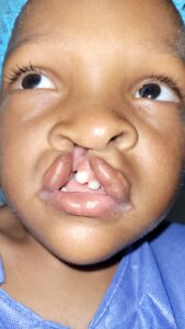 Niño con labios leporinos